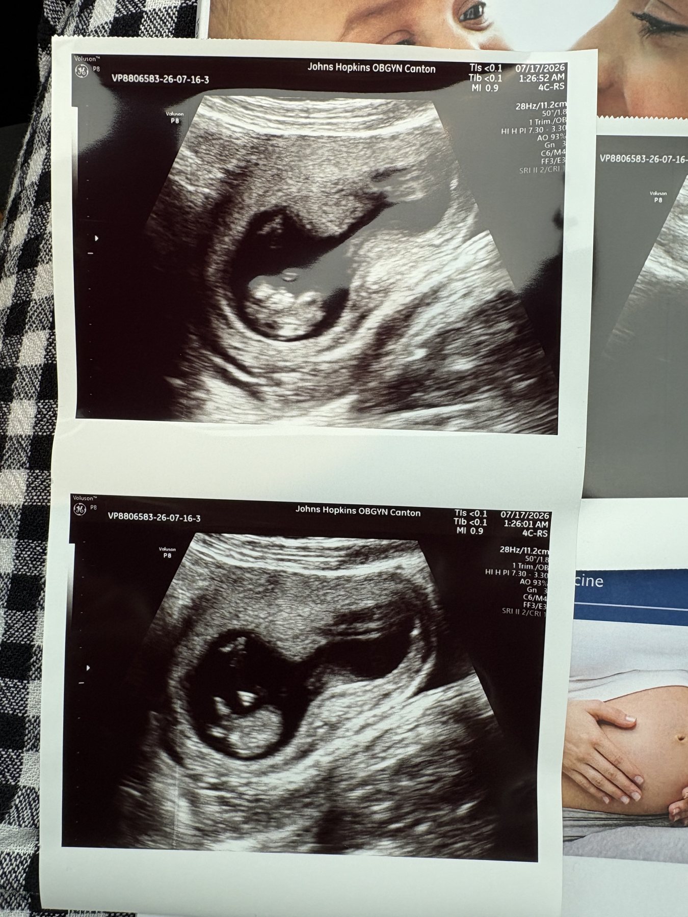 Ellie's first sonogram photos